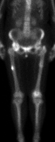 First example of atypical femur fracture
