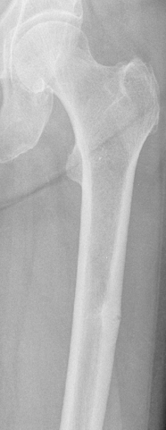 Second example of atypical femur fracture