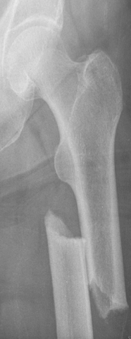 Third example of atypical femur fracture