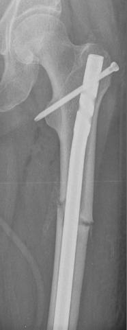 Fourth example of atypical femur fracture